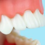 Common Problems Patients Have With Snap-On Dentures