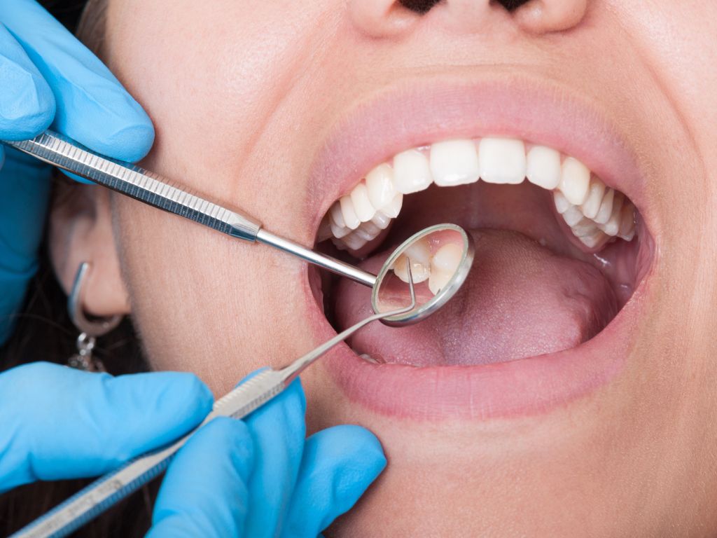 Amalgam vs. Composite Fillings: What You Need To Know