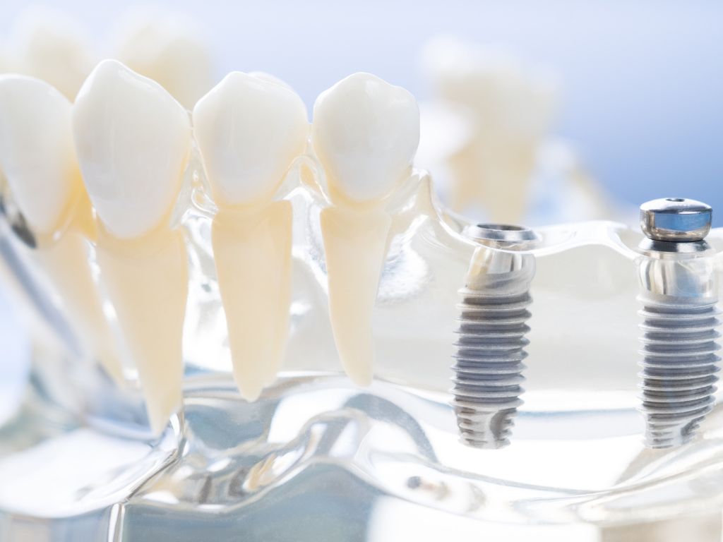 3 Factors To Consider Before Getting Dental Implants