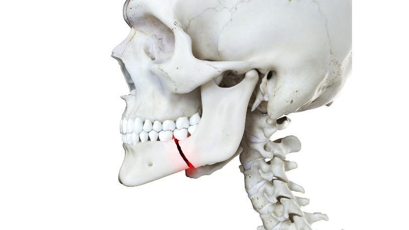 injured-your-jaw