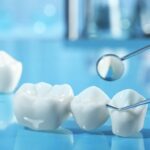 Dental Veneers vs. Crowns: What’s the Difference?