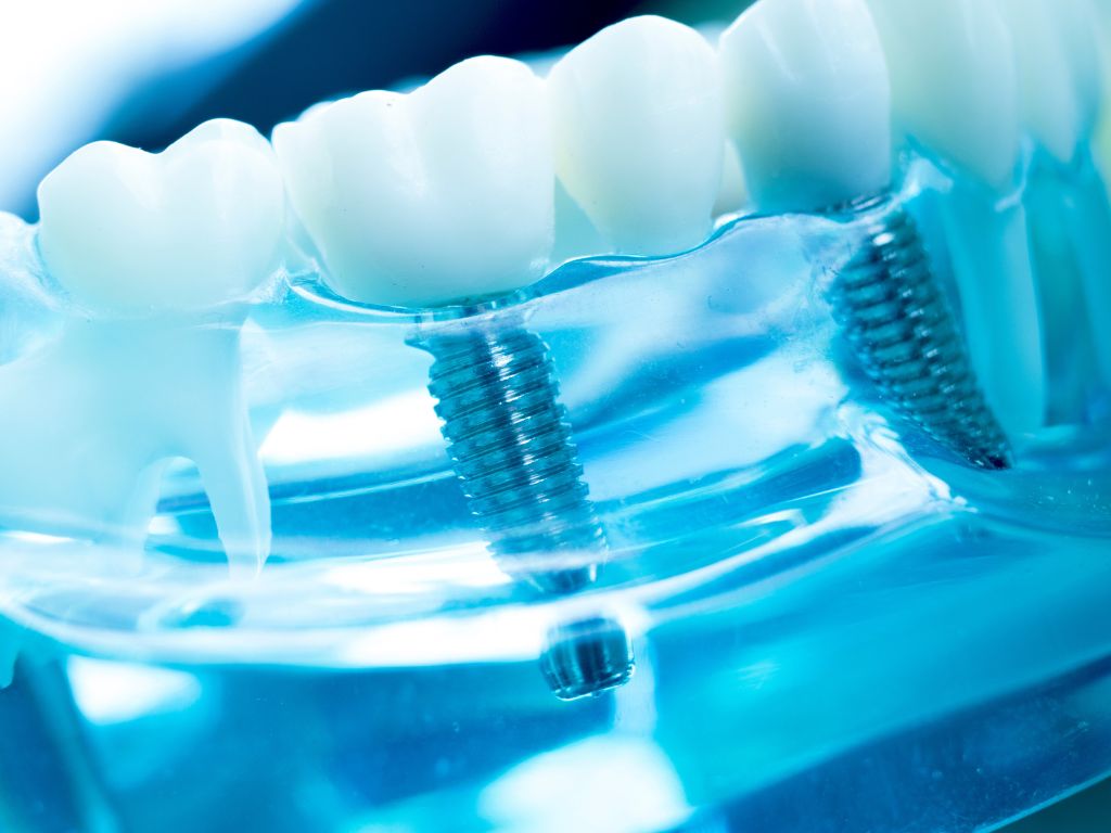 What To Know About Dental Implants for Seniors