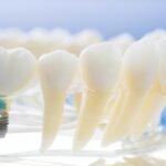 Why Bone Grafts Are Important for Dental Implants