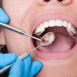 Amalgam vs. Composite Fillings: What You Need To Know
