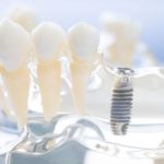 3 Factors To Consider Before Getting Dental Implants