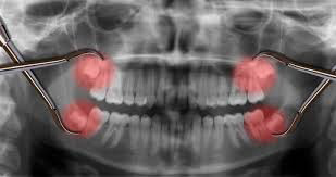 wisdom-teeth-can-become-inflamed-and-painful
